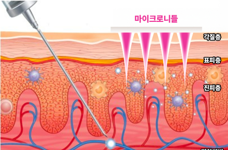 라파스, 세계 최초 '비염 패치' 임상 1상 성공...안전성·효과·용량 1/10 까지